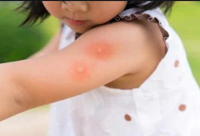 Common Insect Allergies